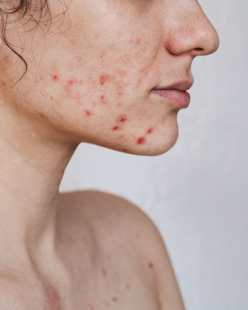 Why your stubborn jawline acne isn't really a skin problem