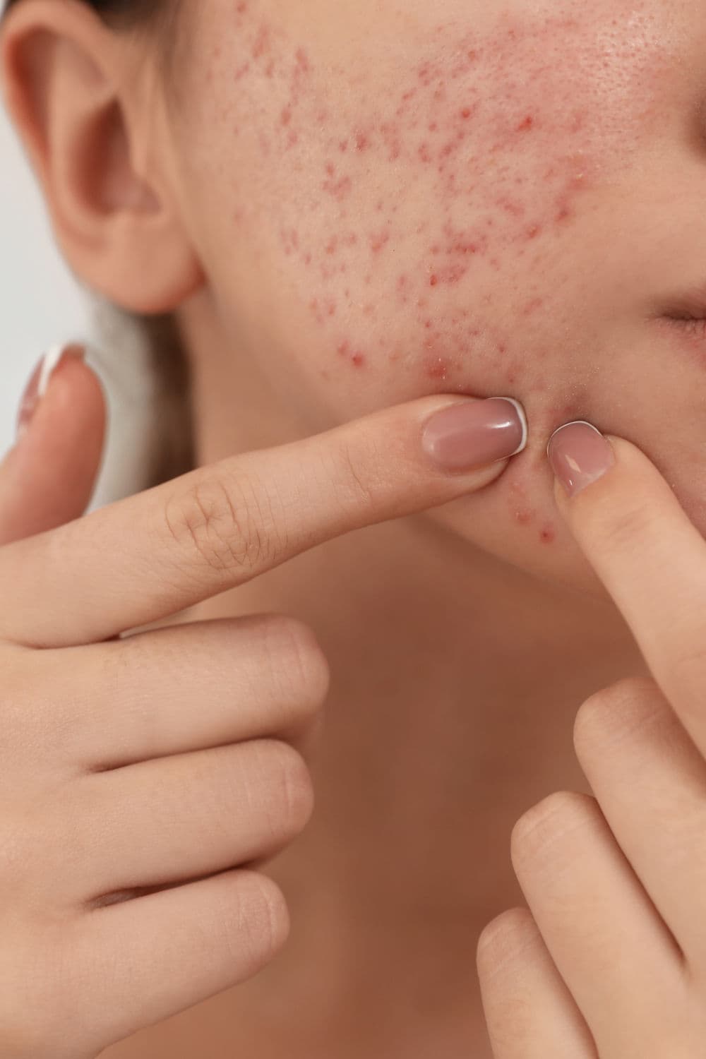 Why your breakouts always hit the same spot